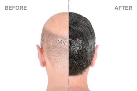 Hair Transplant Prices in Turkey All Inclusive Cost